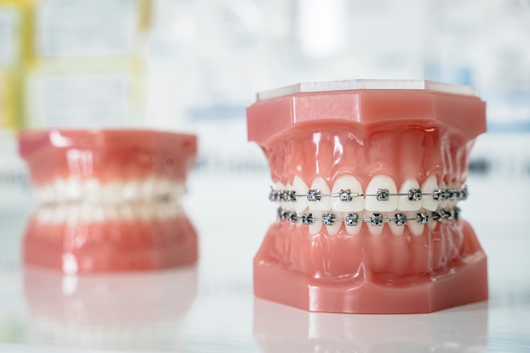 Braces- Orthodontics in Irvine