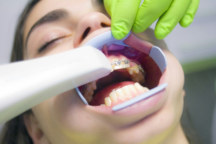 Braces- Orthodontics in Irvine