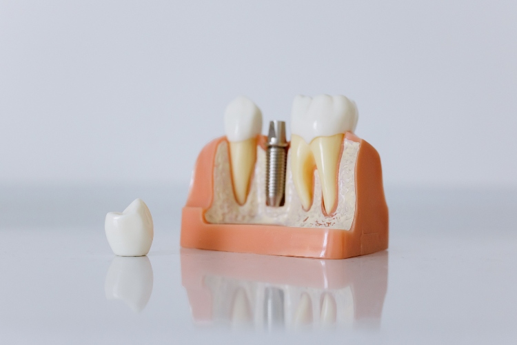 Lake Forest Dentist - Dental Implants